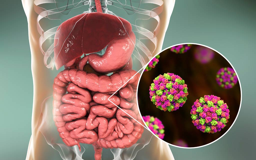 norovirus-food-illness